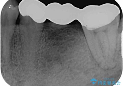 激痛の奥歯のむし歯治療 折角なので矯正治療もしたいの治療前