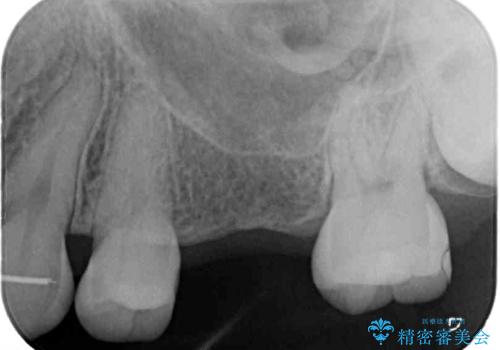 矯正の後戻りと奥歯の欠損 ワイヤー矯正とインプラント治療の治療前