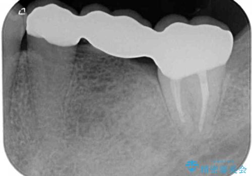 激痛の奥歯のむし歯治療 折角なので矯正治療もしたいの治療後
