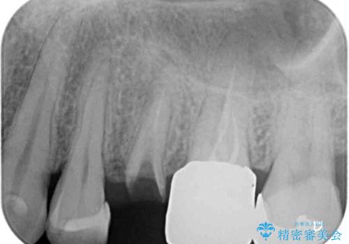 抜歯が必要な小臼歯　インプラントによる補綴治療の治療前