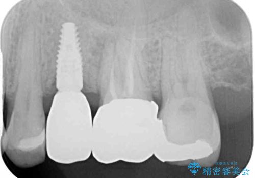 抜歯が必要な小臼歯 インプラントによる補綴治療の治療後