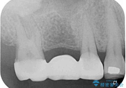 奥歯のブリッジが痛い オールセラミックブリッジでのむし歯治療の治療前