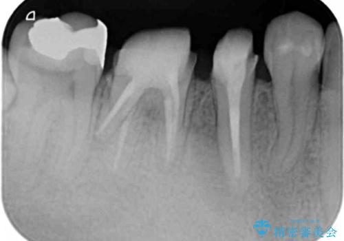 深い虫歯 セラミッククラウンの精度を高める歯周外科手術の治療中