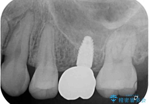 矯正の後戻りと奥歯の欠損 ワイヤー矯正とインプラント治療の治療後