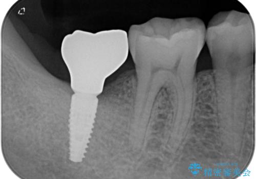 部分矯正で咬み合わせを改善 奥歯のインプラント治療の治療後