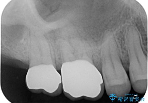 歯周外科処置を併用した奥歯のむし歯治療の治療後