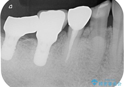 咬合力で欠けてしまった歯 丈夫なセラミッククラウンでの補綴治療の治療前