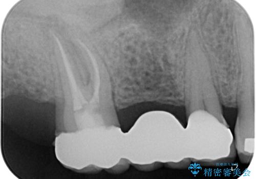 奥歯のブリッジが痛い　オールセラミックブリッジでのむし歯治療の治療後