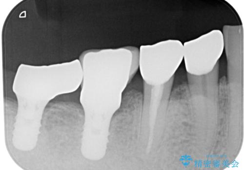 咬合力で欠けてしまった歯 丈夫なセラミッククラウンでの補綴治療の治療後
