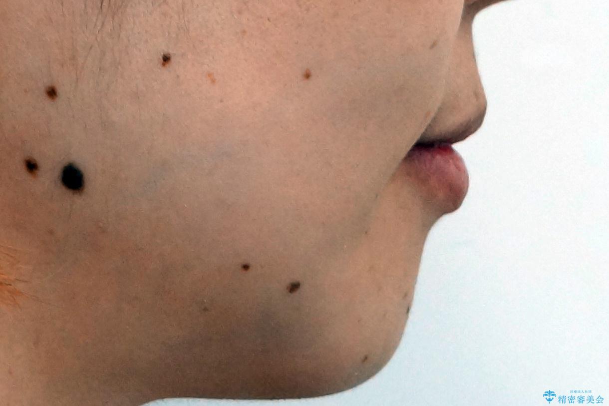 犬歯が歯ぐきにうまっている 真ん中のずれ、出っ歯を治したいの治療後(顔貌)