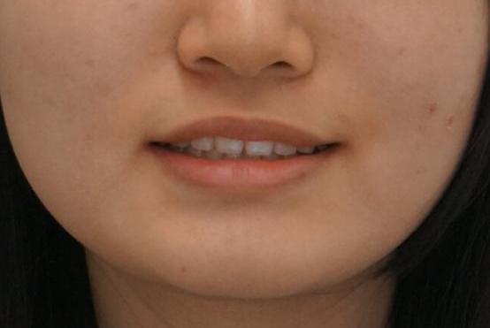 前歯のすき間が気になる 部分矯正での治療後(顔貌)