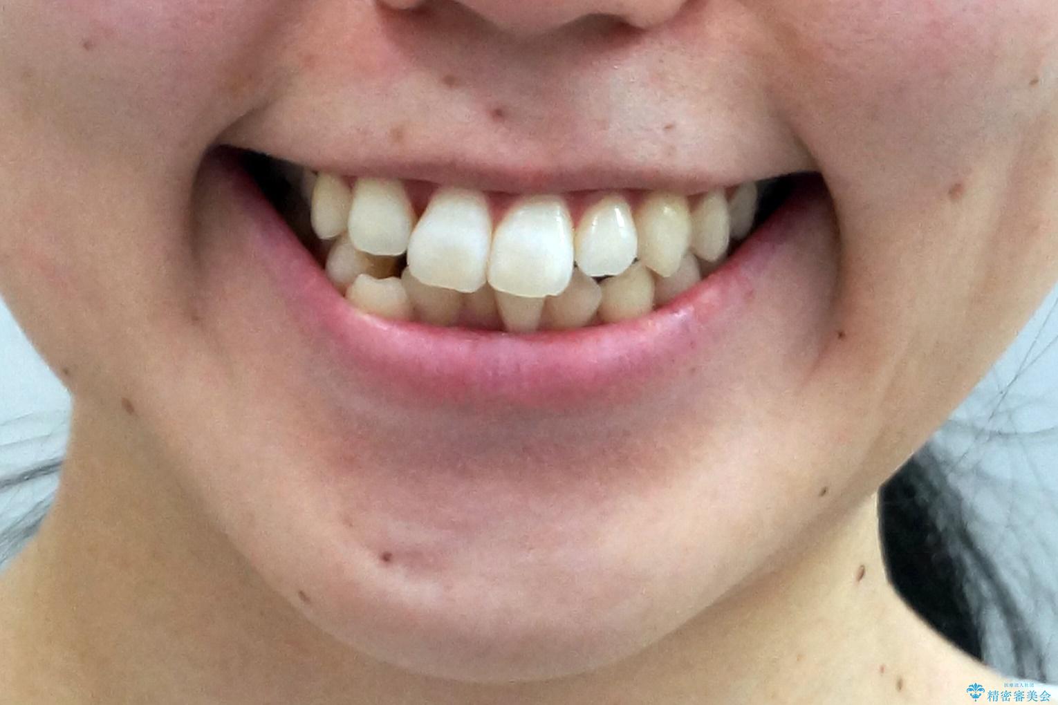 犬歯が歯ぐきにうまっている 真ん中のずれ、出っ歯を治したいの治療前(顔貌)