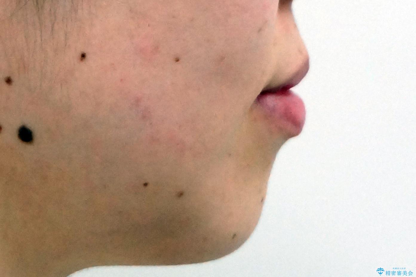 犬歯が歯ぐきにうまっている 真ん中のずれ、出っ歯を治したいの治療前(顔貌)