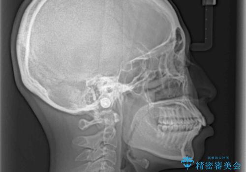 くちばしのような前歯 抜歯矯正で口を閉じやすくの治療前