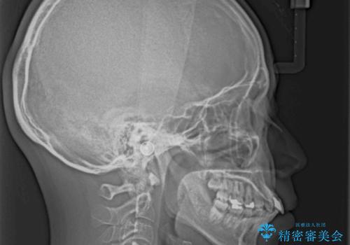 突出した前歯を引っ込める ワイヤー装置での抜歯矯正の治療前