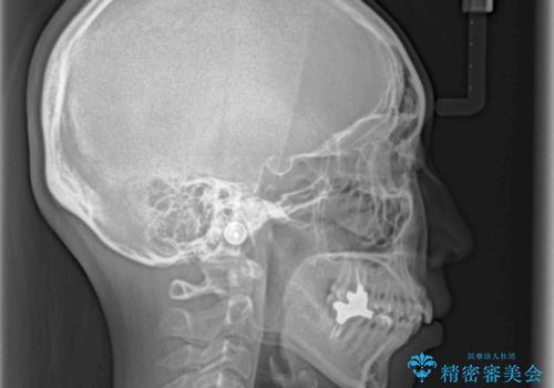 目立たない裏側装置でデコボコをきれいに解消の治療前