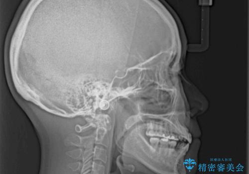【モニター】後戻りでできた隙間 ワイヤー装置での再矯正の治療前