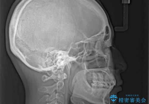 くちばしのような前歯 抜歯矯正で口を閉じやすくの治療後