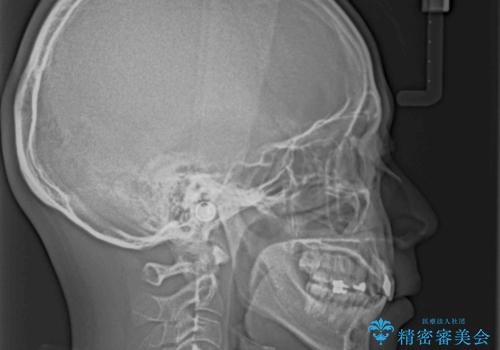 突出した前歯を引っ込める ワイヤー装置での抜歯矯正の治療後