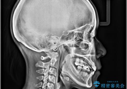 【モニター】後戻りでできた隙間 ワイヤー装置での再矯正の治療後