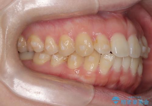 前歯のガタツキをインビザラインで改善の治療中