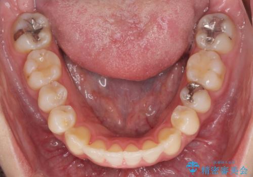 引っ込んだ前歯を並べたい マウスピースと部分ワイヤーのコンビネーション矯正の治療後