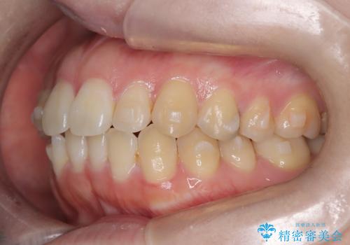 前歯のガタツキをインビザラインで改善の治療中