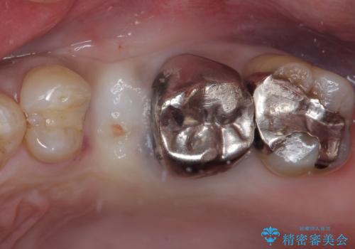 抜歯が必要な小臼歯　インプラントによる補綴治療の治療中