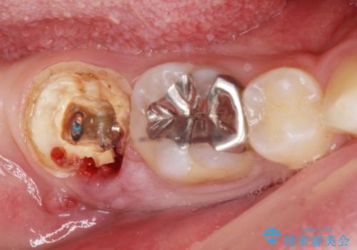 銀歯を白くしたい。(インプラント治療)の治療中