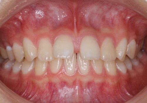 前歯のすき間が気になる　部分矯正での症例 治療前