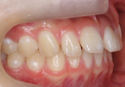 前歯のすき間が気になる　部分矯正での治療前