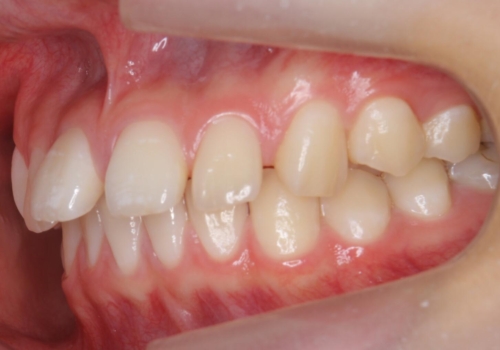 前歯のすき間が気になる 部分矯正での治療前