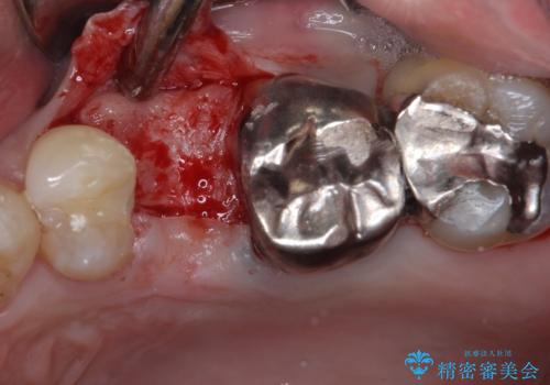 抜歯が必要な小臼歯 インプラントによる補綴治療の治療前