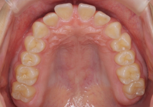 前歯のすき間が気になる　部分矯正での治療前