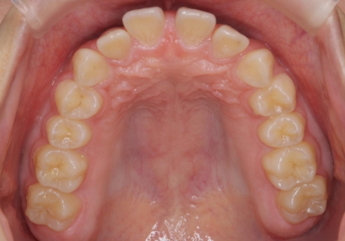 前歯のすき間が気になる 部分矯正での治療前