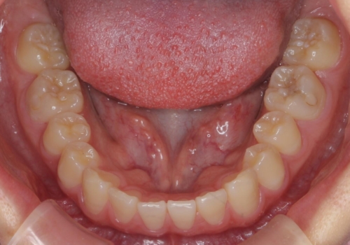 前歯のすき間が気になる 部分矯正での治療前