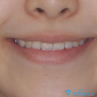 前歯のクロスバイトを改善 インビザライン・モデレートによる矯正治療の治療後(顔貌)