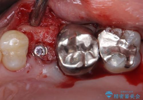 抜歯が必要な小臼歯 インプラントによる補綴治療の治療中