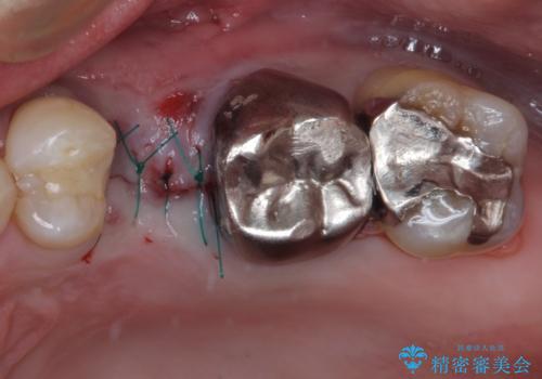抜歯が必要な小臼歯 インプラントによる補綴治療の治療後