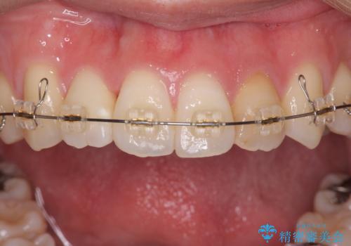 引っ込んだ前歯を並べたい マウスピースと部分ワイヤーのコンビネーション矯正の治療中
