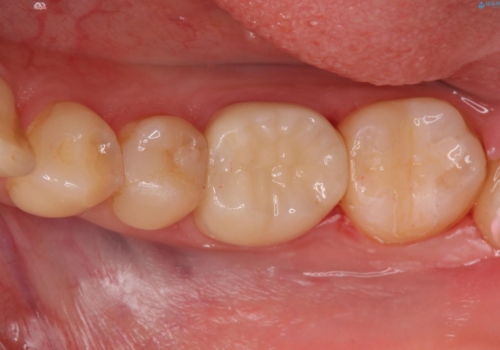 精度の低い詰め物のやり替えの症例 治療後