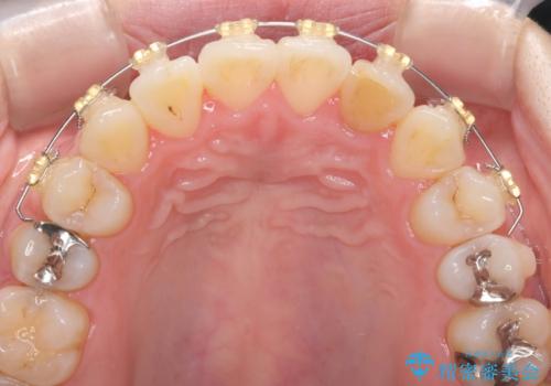 引っ込んだ前歯を並べたい　マウスピースと部分ワイヤーのコンビネーション矯正の治療中