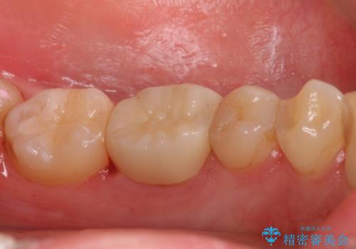 精度の低い詰め物のやり替えの治療後