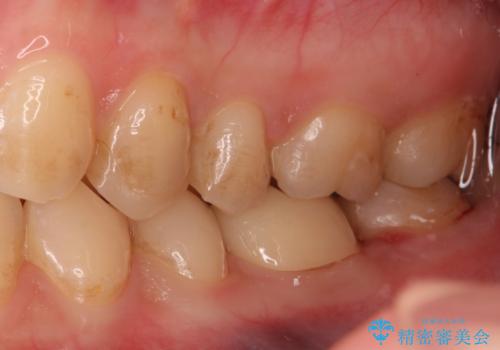 精度の低い詰め物のやり替えの治療後