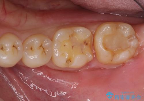 銀歯の横が虫歯、自費治療でやり直してセラミックにの治療中