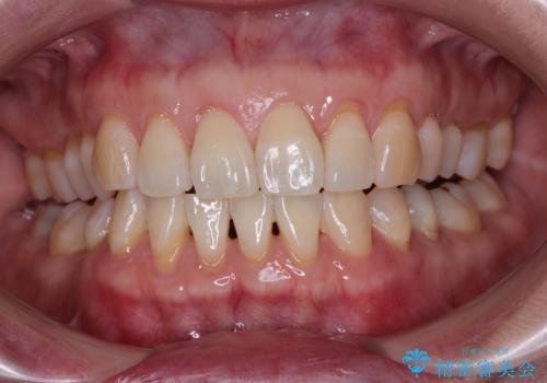 下がってきた歯茎を何とかしたい　歯肉移植による歯肉退縮の改善の症例 治療前