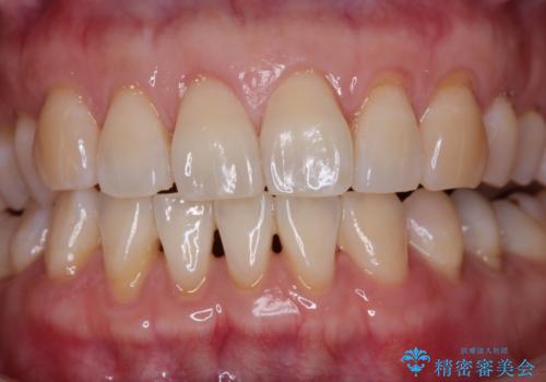 下がってきた歯茎を何とかしたい　歯肉移植による歯肉退縮の改善の治療前
