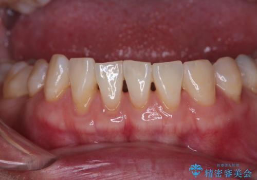 下がってきた歯茎を何とかしたい　歯肉移植による歯肉退縮の改善の治療前