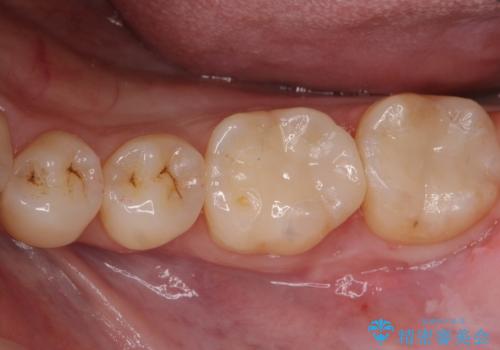 銀歯の横が虫歯、自費治療でやり直してセラミックにの治療後
