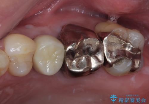 抜歯が必要な小臼歯　インプラントによる補綴治療の症例 治療後